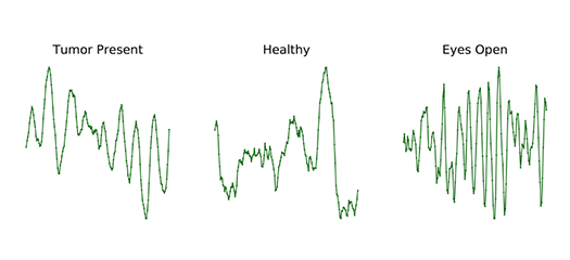 example data of normal and abnormal arrhythmia classification